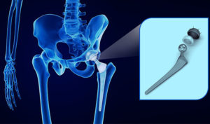 Lire la suite à propos de l’article 300.000 € pour une infection de  prothèse de hanche