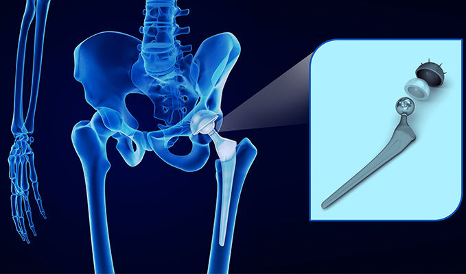 Lire la suite à propos de l’article 300.000 € pour une infection de  prothèse de hanche